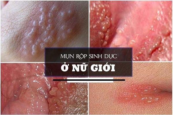 mụn rộp sinh dục