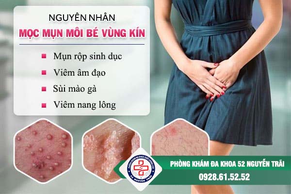 mụn vùng kín nữ