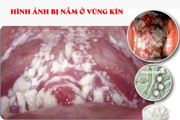 Hình ảnh nấm vùng kín ở nữ