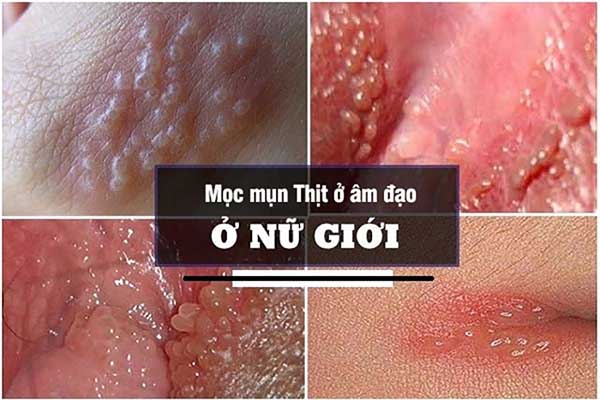 mụn thịt ở âm đạo