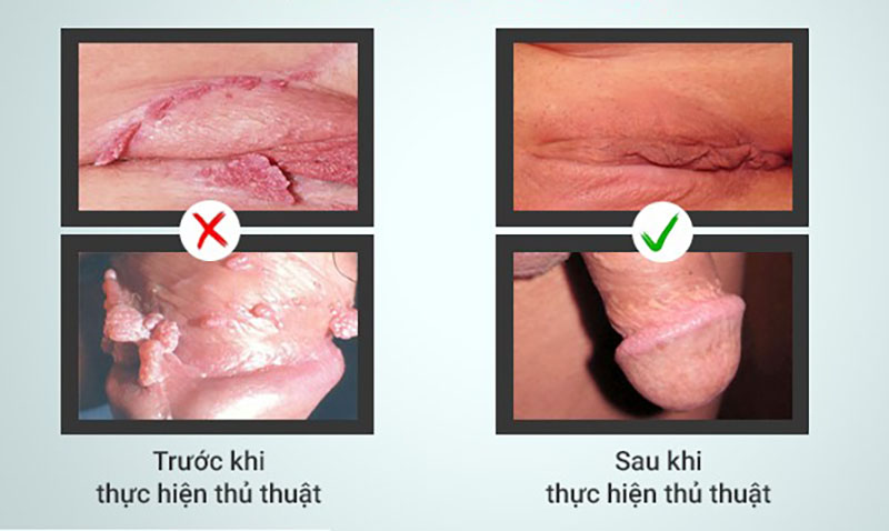 truoc-va-sau-dieu-tri-suiđs